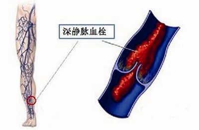 下肢深静脉瓣膜功能不全，何时手术合适？【下肢深静脉瓣膜功能不全】