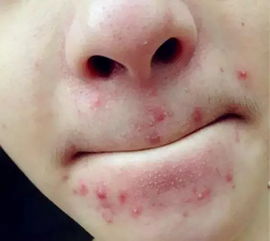 嘴附近长痘痘是什么原因 身体状况挺好的，可是嘴巴周围总起痘痘怎么回事？ 