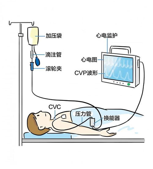 哪些因素影响中心静脉压