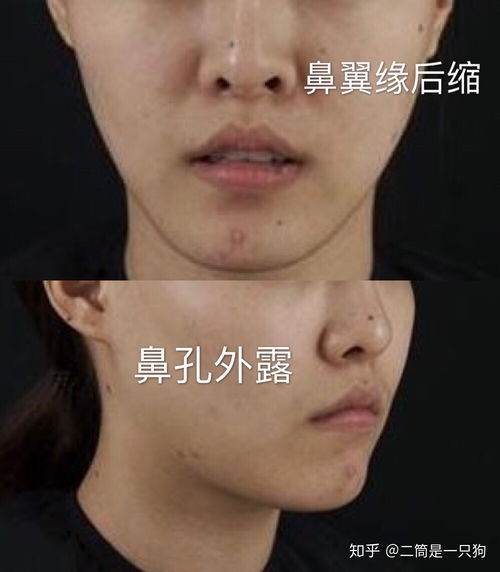 鼻孔外露和朝天鼻的区别图片