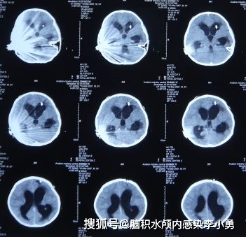 5岁儿童因电子耳蜗安装术所致交叉性偏瘫和严重颅内感染,已14岁