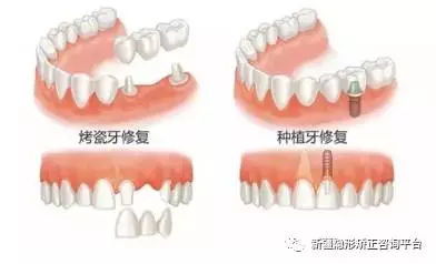 种植牙,我们的第三个青春 搜狐健康 搜狐网 