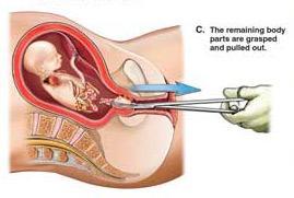 流产的胎儿是怎么被残忍取出的 看完之后罪孽深重 