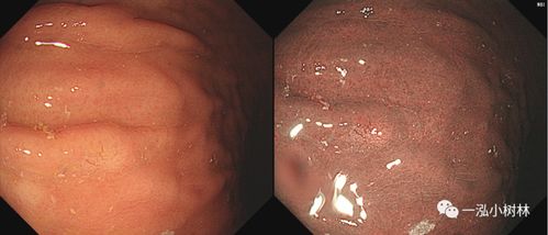 褪色病变的内镜诊断