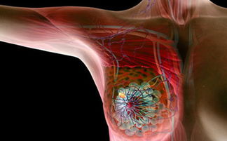 乳腺癌可直接向周围扩展
