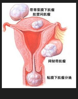 子宫肌瘤吃什么能消除