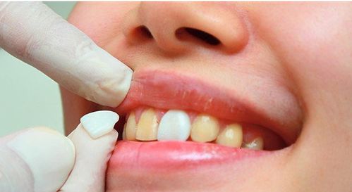 牙齿美白的方法有哪些呢 