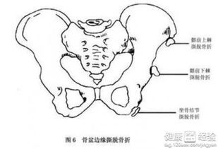 梦见自己骨盆骨折(梦到自己盆骨一侧断裂)