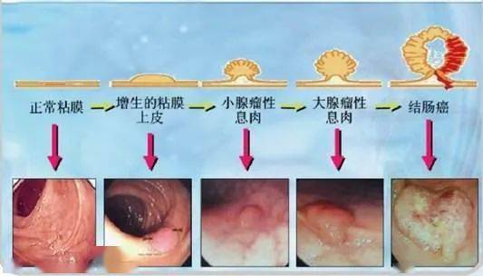 医生不建议做肠镜肠子疼