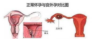 宫外孕的症状 信息图文欣赏 信息村 K0w0m Com