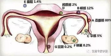 宫外孕症状(宫外孕有什么症状)