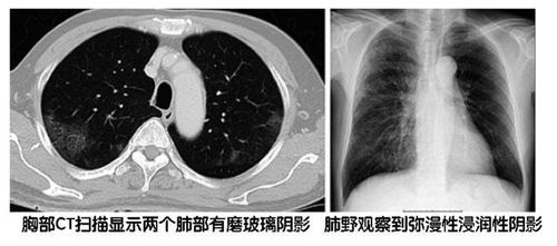 遭遇间质性肺炎 E7080治疗不明原发灶的鳞状细胞癌 