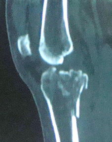 手术分享胫骨平台粉碎性骨折 图片欣赏中心 急不急图文 Jpjww Com