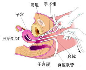 图解流产全过程和那些有流产史的女星们 