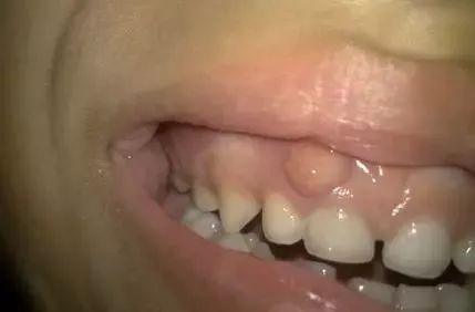 牙龈反复长脓包的人注意了 可能是这两个原因导致的