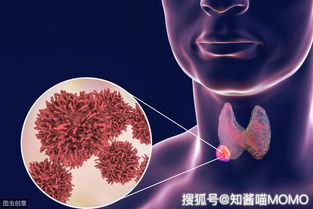 记住不是所有甲状腺结节都需要开刀,手术不要太盲目