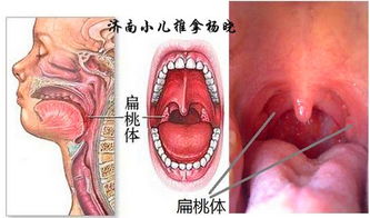 正常扁桃体图片大全 搜狗图片搜索