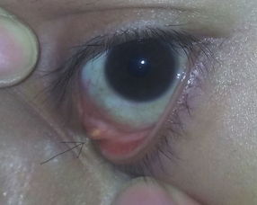 眼角上是什么东西 据说是翼状胬肉 对眼睛有什么影响 怎么治疗呢 