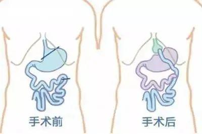 一年减重60斤 小小手术帮 胖友 和肉肉说拜拜