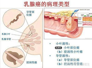 做完乳腺癌手术后的图 搜狗图片搜索