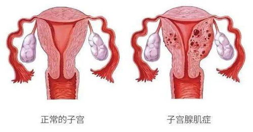 同时患有子宫腺肌病 子宫肌瘤 卵巢子宫内膜异位囊肿,怎么办