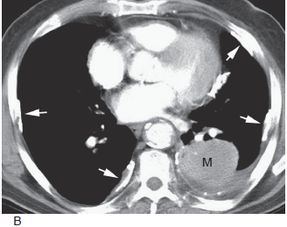 肺癌的影像学表现 上 多图