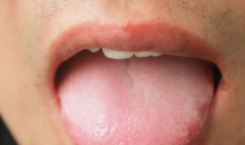 舌苔厚白是什么原因？舌苔发白是什么原因啊