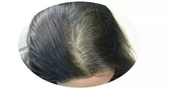 注意 头皮出油严重脱发 头发细软又稀少 发际线高前额光秃 这样做可以得到改善