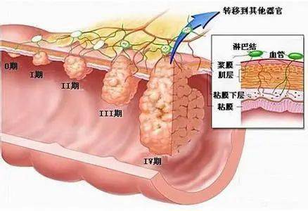 从便血到癌症晚期,再到去世,他用了半年时间