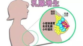 乳腺癌是怎么来的 你知道吗 只需四步