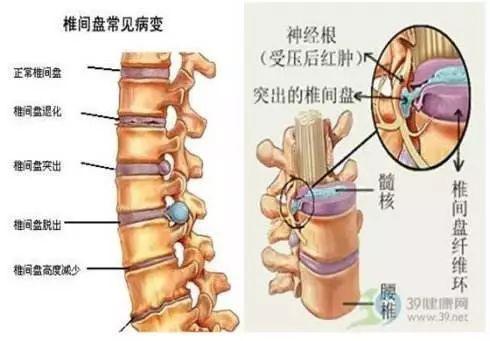 肩颈腿腰椎,哪里疼痛贴哪里 这款生姜贴还真的很给力