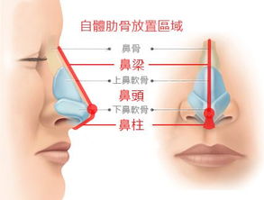 半肋骨鼻跟全肋骨鼻有什么区别