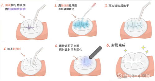 窝沟封闭价格？孩子做窝沟封闭多少钱