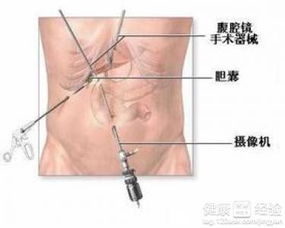 胆囊切除术后一年半大便不尽怎么办