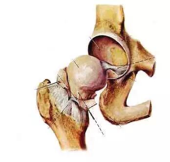 美国关节卫士Osteo对股骨头坏死有哪些功效？