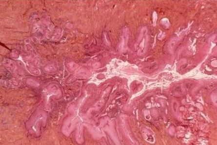 宫,颈,癌的4个明显症状,越早发现越好 病毒 