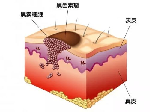 万名网友全身找痣 网红医生粗暴建议 长这三个部位都要切除