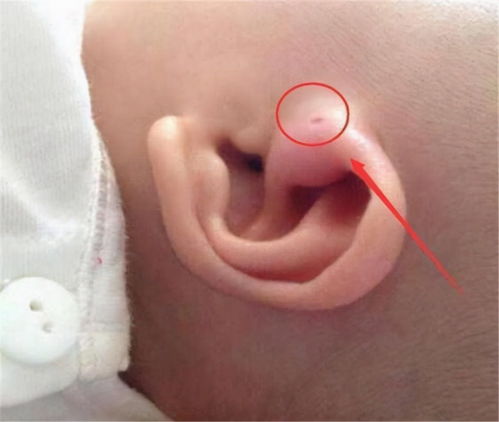 耳朵前面的小洞是怎么回事 一文读懂耳前瘘管