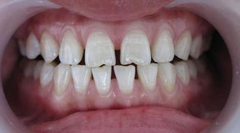 牙齿稀疏是什么原因导致的 