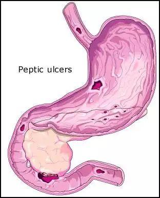 消化道溃疡能做心脏搭桥吗 