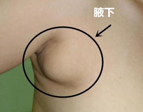 副乳？副乳腺和副乳一样吗