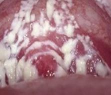 淋球菌尿道炎症状图片