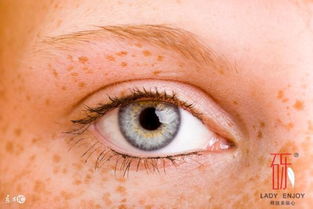你以为长斑只影响美观,其实是癌症的前兆 如何预防面部色斑 