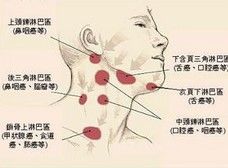 淋巴结发炎，淋巴发炎有什么症状