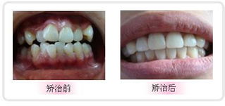 矫正牙齿哪种方法最好