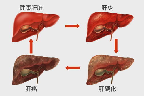 吴孟达达因肝癌去世,肝癌为何如此可怕,5年生存率仅为12