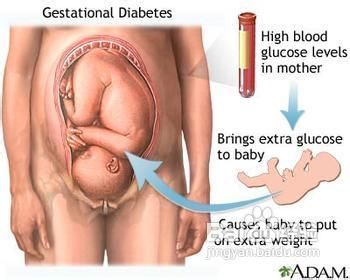 原创孕期一旦有这6个症状，就要预防妊娠糖尿病了