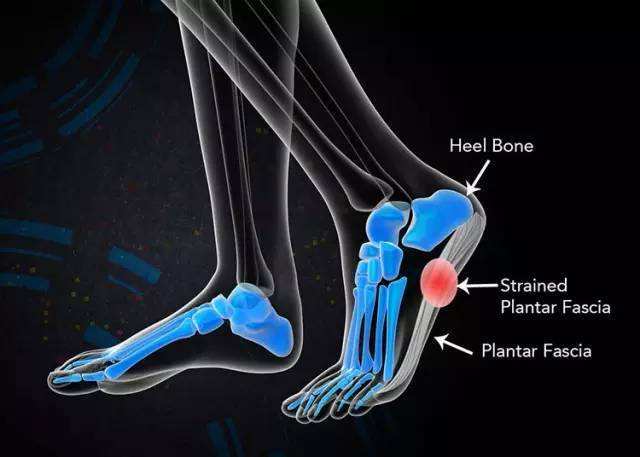 困扰跑者的足底筋膜炎,如何康复锻炼缓解 