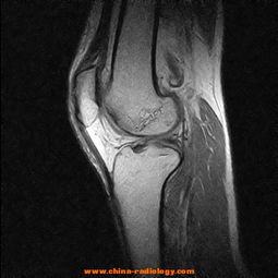 膝关节骨软骨损伤图片 搜狗图片搜索