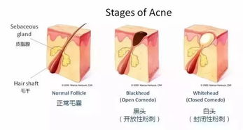 反复长痘、闭合粉刺、黑头是什么原因